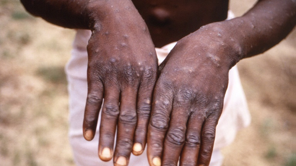 Fears new 'most dangerous' mpox strain could cross borders